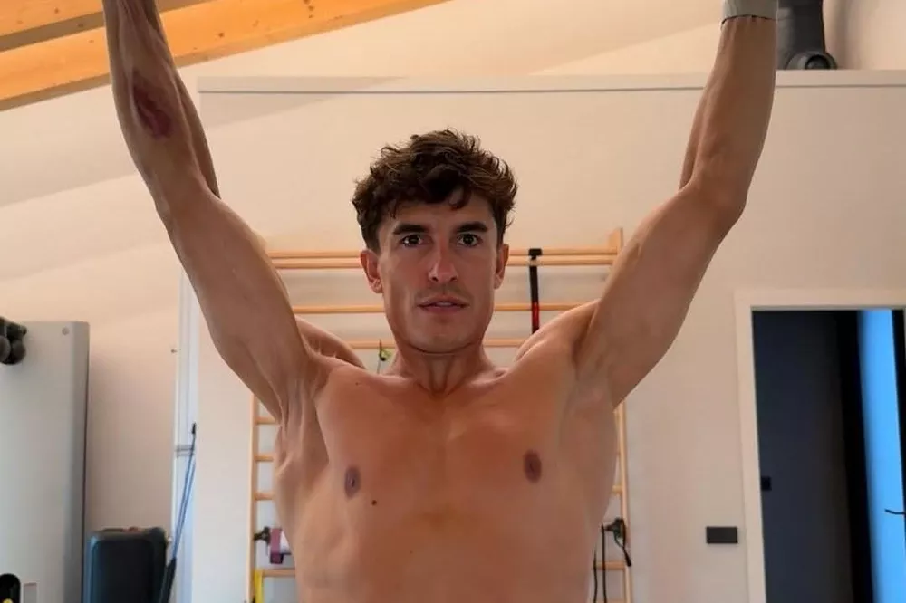 Marc M&aacute;rquez, right arm, Arag&oacute;n